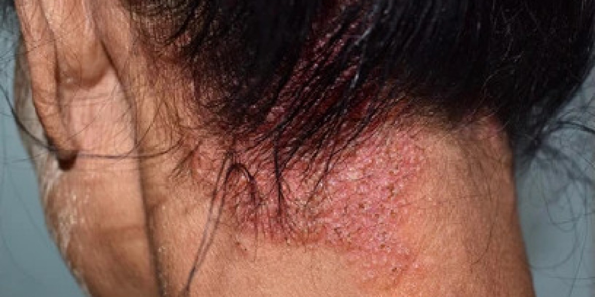 Ivermectin 6mg – Effective Relief from Scabies and Strongyloidiasis